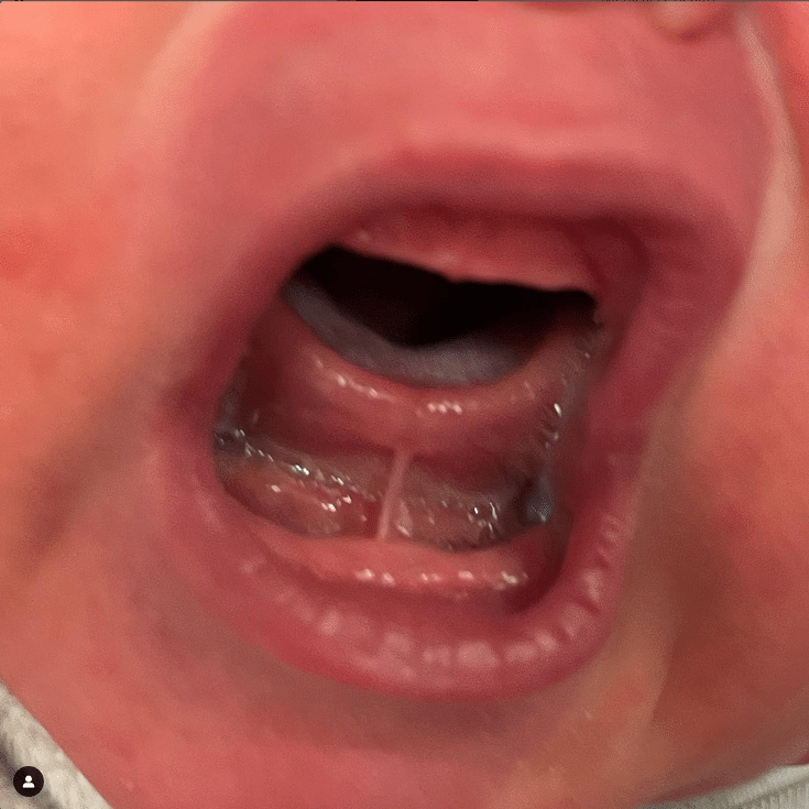 Mississippi Tongue Tie Center Life Dental Group
